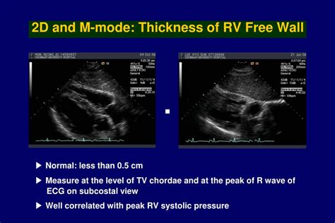 rv wall thickness echo